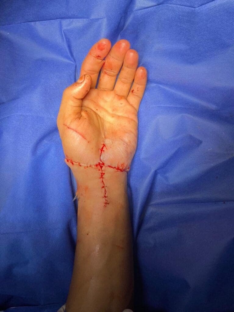 شاهد.. إعادة زرع يد مبتورة بالكامل لمريض يطوارئ قصر العيني 15 IMG 20241213 WA0055 صيدلة بني سويف شاهد.. إعادة زرع يد مبتورة بالكامل لمريض يطوارئ قصر العيني موقع في الجامعة