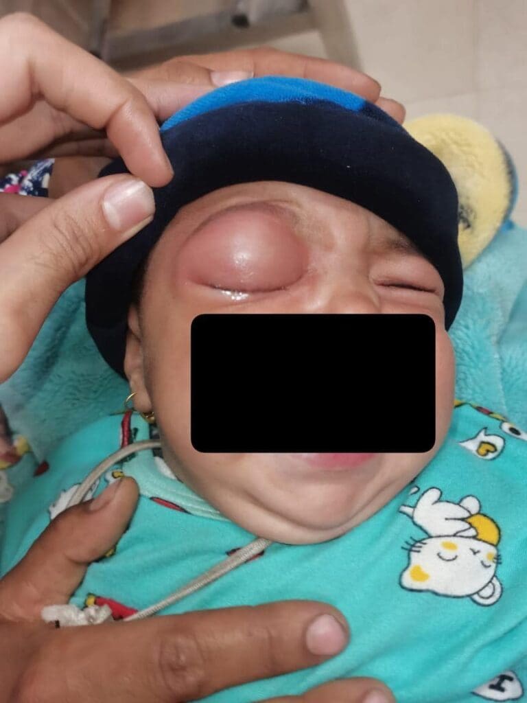 بعد حرمان العين من الرؤية.. قسم طب وجراحة العيون بسوهاج ينجح في إنقاذ رضيعة-صور 12 ورم في الجامعة بعد حرمان العين من الرؤية.. قسم طب وجراحة العيون بسوهاج ينجح في إنقاذ رضيعة-صور موقع في الجامعة