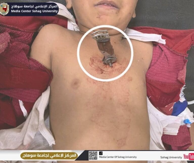 أشبه بالمعجزة.. مستشفيات سوهاج الجامعية تنجح في إنقاذ طفل تعرص لطعنة نافذة بالقلب 8 FB IMG 1750686414993 جامعة أشبه بالمعجزة.. مستشفيات سوهاج الجامعية تنجح في إنقاذ طفل تعرص لطعنة نافذة بالقلب موقع في الجامعة