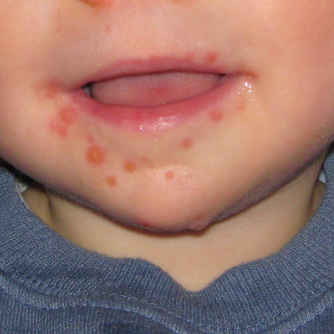 Hand Foot Mouth Disease مدرسة ماذا قالت مدرسة الألسن الدولية بعد إصابة 4 طلاب بفيروس HFMD؟ موقع في الجامعة