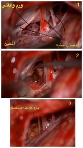 إنجاز طبي بمستشفيات جامعة أسيوط… استئصال "وحمة دموية" من جذع مخ شاب بنجاح تام 2 FB IMG 1767789670850 جامعة أسيوط إنجاز طبي بمستشفيات جامعة أسيوط… استئصال "وحمة دموية" من جذع مخ شاب بنجاح تام موقع في الجامعة