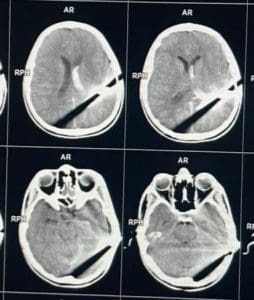 نجاح جراحة دقيقة ينقذ شابًا من إصابة نافذة بالمخ في مستشفى طوارئ قصر العيني 2 نجاح جراحة دقيقة ينقذ شابًا من إصابة نافذة بالمخ في مستشفى طوارئ قصر العيني