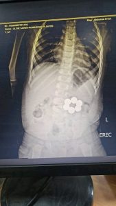 جامعة المنصورة تنقذ رضيعًا ابتلع 6 قطع مغناطيس دون تدخل جراحي 5 1775575160899 جامعة المنصورة جامعة المنصورة تنقذ رضيعًا ابتلع 6 قطع مغناطيس دون تدخل جراحي موقع في الجامعة