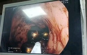 جامعة المنصورة تنقذ رضيعًا ابتلع 6 قطع مغناطيس دون تدخل جراحي 4 1775575167473 جامعة المنصورة جامعة المنصورة تنقذ رضيعًا ابتلع 6 قطع مغناطيس دون تدخل جراحي موقع في الجامعة