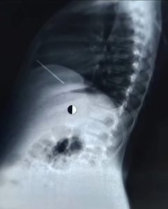 ملحمة طبية بقصر العيني.. إنقاذ طفل من مسمار اخترق القلب في جراحة دقيقة خلال دقائق 7 1b5c49a2 7f4b 4635 a9f6 7ff43859606a إنقاذ طفل من مسمار اخترق القلب ملحمة طبية بقصر العيني.. إنقاذ طفل من مسمار اخترق القلب في جراحة دقيقة خلال دقائق موقع في الجامعة