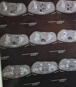 FB IMG 1776271434919 جامعة كفر الشيخ فريق العظام بجامعة كفر الشيخ يحقق إنجازًا طبيًا جديدًا في حالة معقدة لإصلاح مفصل الفخذ موقع في الجامعة