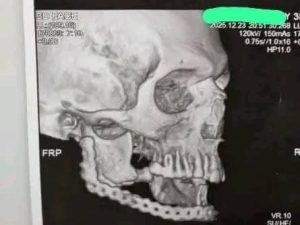 FB IMG 1778698586108 نجاح إعادة بناء الفك السفلي بمستشفيات جامعة بني سويف جراحة دقيقة تُعيد الأمل لمريض خمسيني.. نجاح إعادة بناء الفك السفلي بمستشفيات جامعة بني سويف موقع في الجامعة