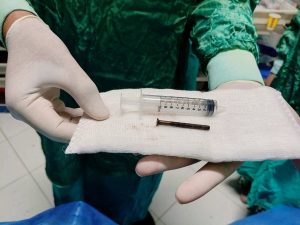 بمنظار الجهاز الهضمي.. جامعة الزقازيق تنجح في استخراج مسمار من طفلة عمرها عامان 2 جامعة الزقازيق تنجح في استخراج مسمار من طفلة عمرها عامان