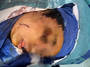 نجاح فريق طبي بقصر العيني في استخراج سكين من قاع الجمجمة 