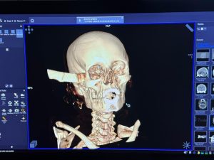 IMG 20260501 WA0048 فريق طبي بقصر العيني نجاح فريق طبي بقصر العيني في استخراج سكين من قاع الجمجمة وإنقاذ شابة من إصابات خطيرة موقع في الجامعة