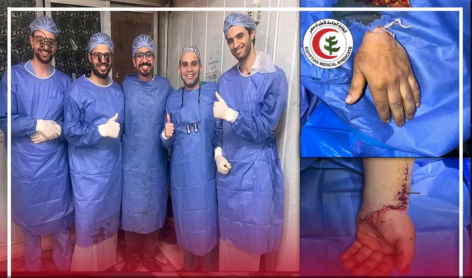 فريق طبي بجامعة طنطا ينجح في إعادة توصيل يد مبتورة