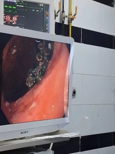 1781443806262 إنجاز طبي نادر بمستشفيات جامعة بني سويف إنجاز طبي نادر بمستشفيات جامعة بني سويف.. استخراج 100 مسمار وصامولة من معدة مريض موقع في الجامعة
