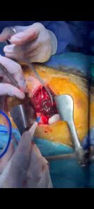إنقاذ شاب من نزيف حول القلب في جراحة دقيقة بمستشفى الطوارئ الجامعي بسوهاج