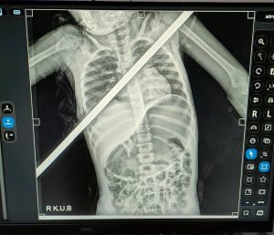 مستشفيات بنها الجامعية تنجح في إنقاذ طفلة 