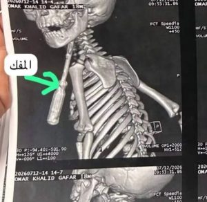 مستشفيات جامعة بنها تنقذ طفلًا بعد اختراق مفك رقبته في جراحة دقيقة 2 مستشفيات جامعة بنها تنقذ طفلًا بعد اختراق مفك رقبته