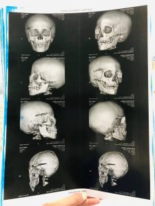 مستشفيات سوهاج الجامعية تنجح في استخراج رصاصة طائشة من مخ طفل وإنقاذه دون مضاعفات 5 1784400024908 مستشفيات سوهاج الجامعية مستشفيات سوهاج الجامعية تنجح في استخراج رصاصة طائشة من مخ طفل وإنقاذه دون مضاعفات موقع في الجامعة