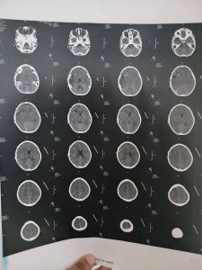 مستشفيات سوهاج الجامعية تنجح في استخراج رصاصة طائشة من مخ طفل وإنقاذه دون مضاعفات 4 1784400030384 مستشفيات سوهاج الجامعية مستشفيات سوهاج الجامعية تنجح في استخراج رصاصة طائشة من مخ طفل وإنقاذه دون مضاعفات موقع في الجامعة