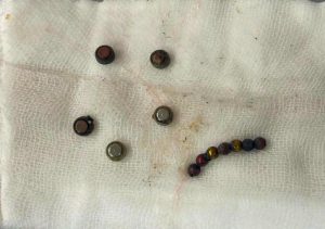 FB IMG 1785252827635 مستشفى الأطفال الجامعي بالمنصورة مستشفى الأطفال الجامعي بالمنصورة ينقذ طفلًا ابتلع 7 بطاريات و13 قطعة مغناطيسية موقع في الجامعة