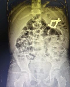 FB IMG 1785252837119 مستشفى الأطفال الجامعي بالمنصورة مستشفى الأطفال الجامعي بالمنصورة ينقذ طفلًا ابتلع 7 بطاريات و13 قطعة مغناطيسية موقع في الجامعة