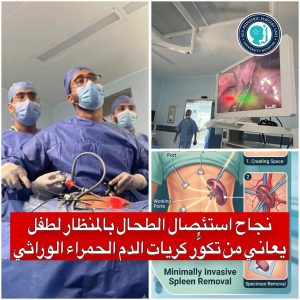 مستشفيات جامعة قناة السويس تنجح في استئصال الطحال  