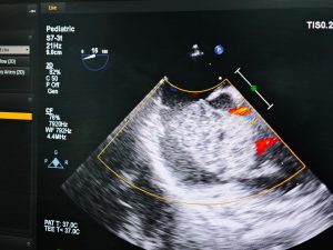 IMG 20260820 WA0042 قصر العيني لأول مرة بقصر العيني.. قسطرة دقيقة تنقذ طفلة سودانية من خثرة قلبية ضخمة مصابة بالعدوى موقع في الجامعة