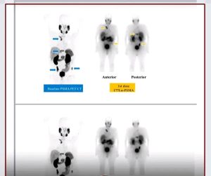 IMG ٢٠٢٦٠٨٢٦ ١٧١٢٣٩ عين شمس تبدأ استخدام تقنية متطورة لعلاج سرطان لأول مرة في المستشفيات الجامعية بمصر.. عين شمس تبدأ استخدام تقنية متطورة لعلاج سرطان البروستاتا المتقدم موقع في الجامعة