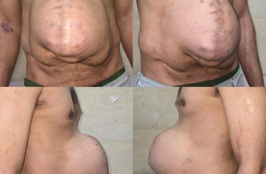 لأول مرة.. مستشفيات جامعة بني سويف تنجح في علاج فتق ضخم بجدار البطن بحقن البوتكس