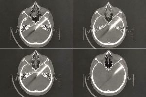FB IMG 1788801480244 مستشفيات جامعة الزقازيق تنقذ حياة شاب في تدخل جراحي مستشفيات جامعة الزقازيق تنقذ حياة شاب في تدخل جراحي بالغ الخطورة بمشاركة 3 تخصصات طبية موقع في الجامعة