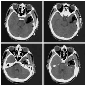 FB IMG 1788801481941 مستشفيات جامعة الزقازيق تنقذ حياة شاب في تدخل جراحي مستشفيات جامعة الزقازيق تنقذ حياة شاب في تدخل جراحي بالغ الخطورة بمشاركة 3 تخصصات طبية موقع في الجامعة