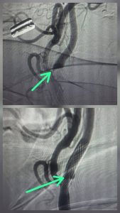 FB IMG 1793100052198 جامعة المنيا تنجح في إجراء 5 تدخلات بالقسطرة جامعة المنيا تنجح في إجراء 5 تدخلات بالقسطرة المخية خلال يوم واحد موقع في الجامعة