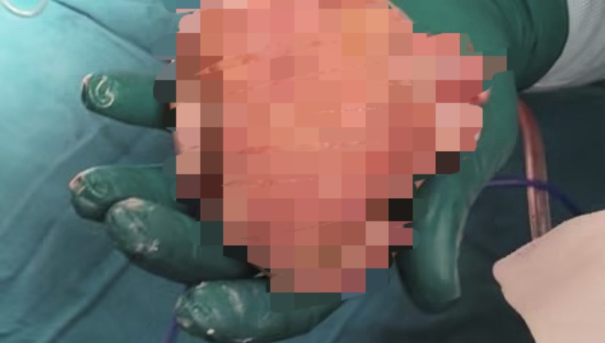 IMG 4512 استخراج تكوين جنيني من معدة طفلة حالة نادرة عالميًا.. استخراج تكوين جنيني من معدة طفلة بمعهد الكبد القومي بالمنوفية موقع في الجامعة